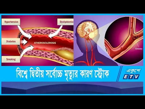 দেশে স্ট্রোকের চিকিৎসা এখনো পর্যাপ্ত নয়