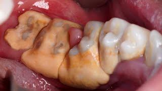 Download lagu 25yo Female. SCALING | Dentist | Dokter Gigi Tri Putra mp3 Download lagu 25yo Female. SCALING | Dentist | Dokter Gigi Tri Putra mp3