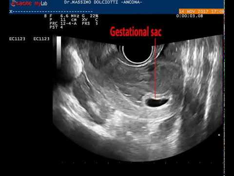 Esercizi per la spalla contratture articolari Unguento circa osteocondrosi