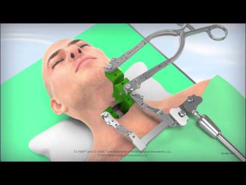 CS-1600L Cervical Retractor Animation