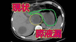 【大腸がんステージⅣ多発肝転移】美味しいご飯をたくさん食べたい・・・。【現在闘病中㉚】
