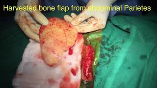 Post surgical calvarial Defect- Cranioplasty - Bone flap replacement