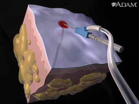 Latest Advancements in Liposuction