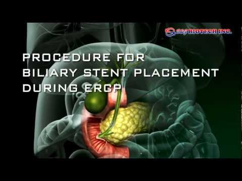 Biliary Stent
