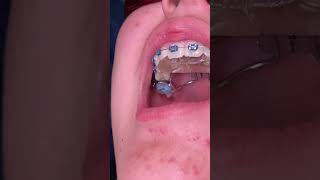 Getting An Expander + Bite Plate - When I get my bottom braces? Tooth Time Family Dentistry Texas