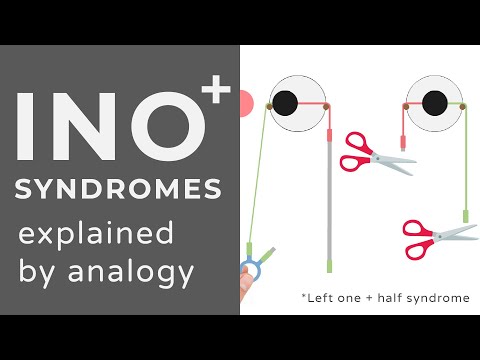 Internuclear Ophthalmoplegia (INO) Plus Syndromes (WEBINO, One and a half..) | Animated Explanation