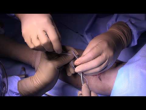 Distal Biceps Tendon Repair