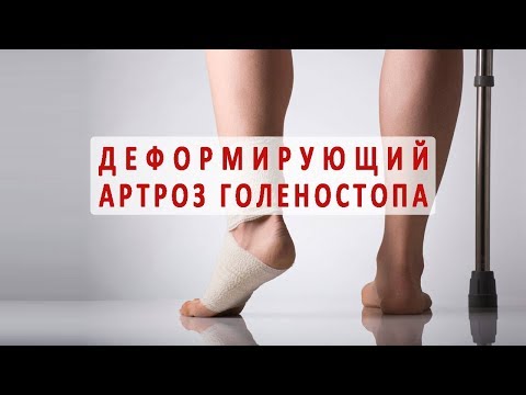 Что нужно знать о деформирующем артрозе голеностопного сустава