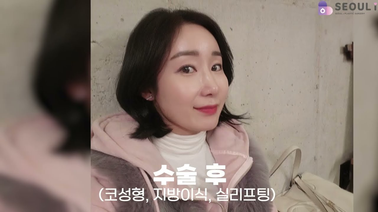 코성형 + 동안패키지 (지방이식+실리프팅) #코성형후기