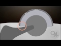 ASTM F2582 Impingement Of Acetabular Prostheses Test Methods