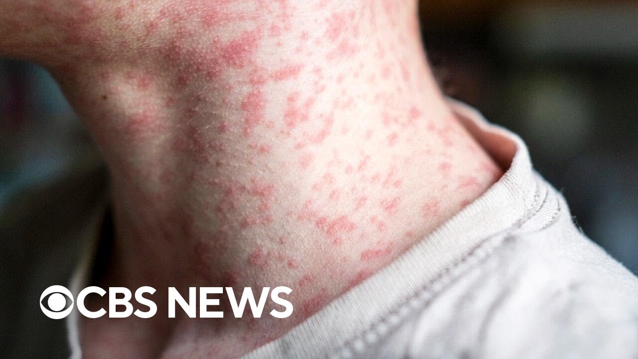 New Mexico adult dies amid growing measles outbreak