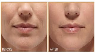 How To Remove wrinkles around the mouth naturally l Tighten sagging skin on face