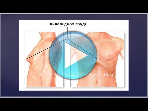 Tag Stomach Deformation