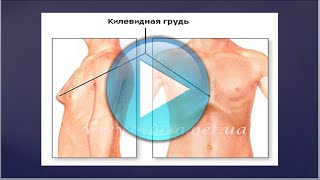 Деформация грудной клетки в 11 лет.