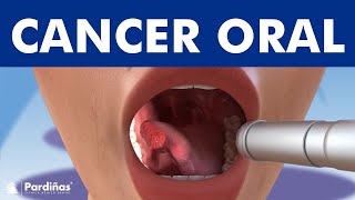 El cáncer oral y los tumores en la boca ©