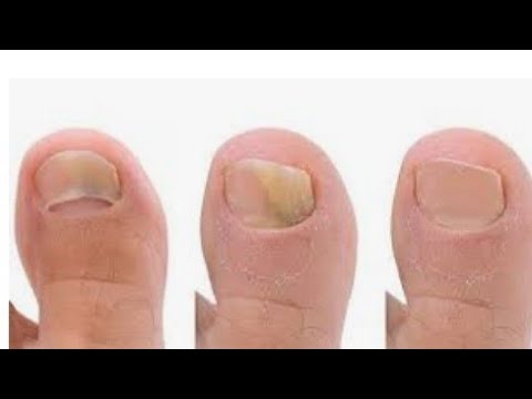 Cum să vindeci ciuperca unghiilor cu peroxid