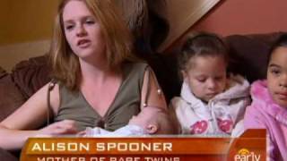 Black and White Twins that surprised the world