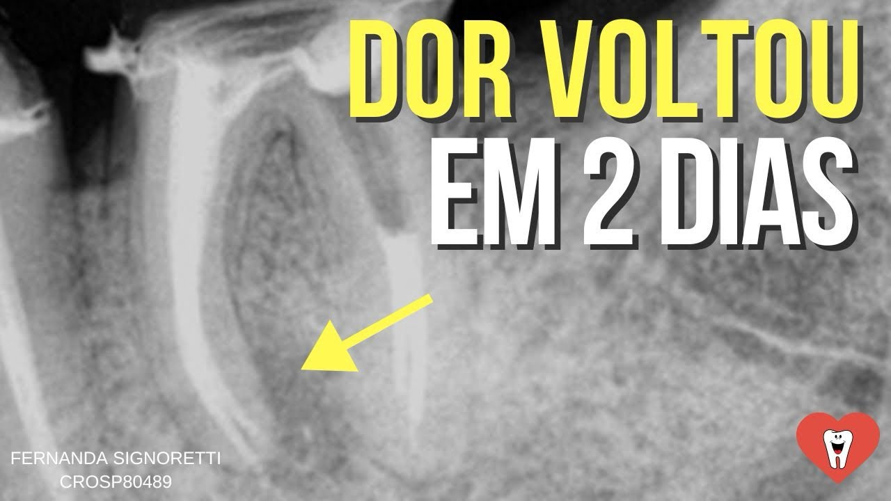 QUAL O ERRO NESSA ENDODONTIA? - Endolovers