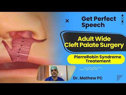 Get Perfect Speech | Adult Wide Cleft Palate Surgery : Pierre Robin Syndrome Treatment In India