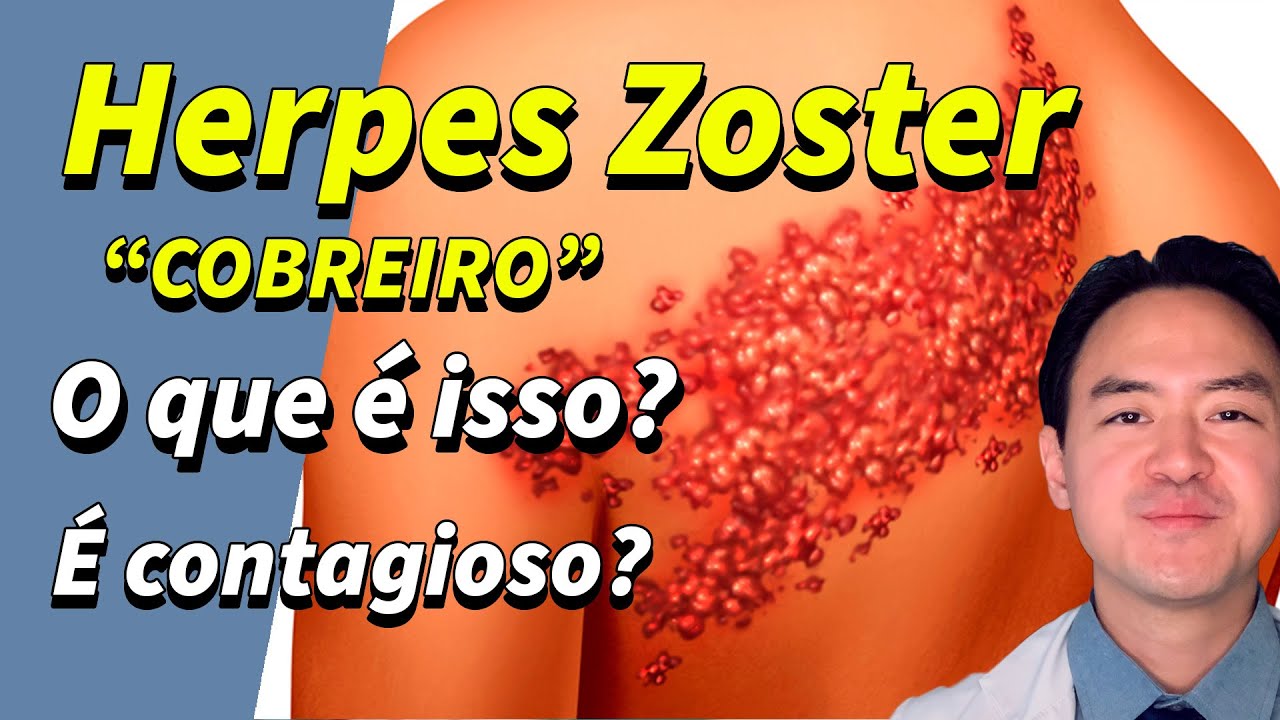 herpes zoster - cobreiro - o que é isso? como prevenir?