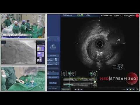 IVUS-Guided PCI Of Complex LCX-OM Bifurcation Lesion