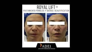 Royal Lift Beautification - Ácido Hialurónico Facial