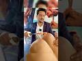 Knee Joints Pain Agni Karma In Ayurveda Dr Amit Bharti Dehradun
