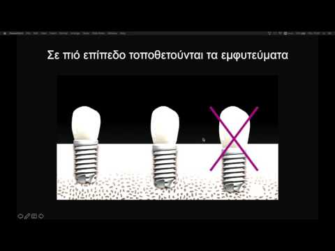 Κοντά και πολύ κοντά εμφυτεύματα (Dental TTT - Webinar Νο 16).