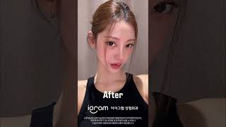 ICL 성형 시술