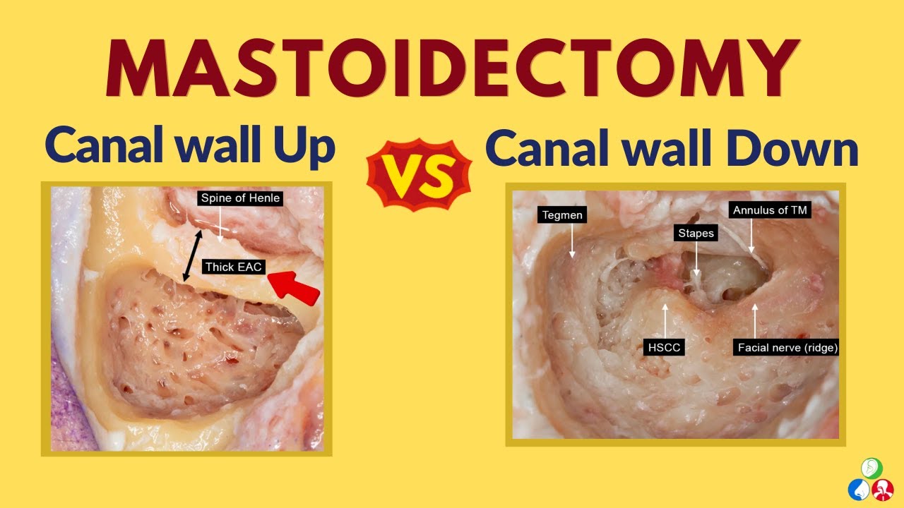 Video thumbnail for Canal wall Down VS Canal wall Up Mastoidectomy