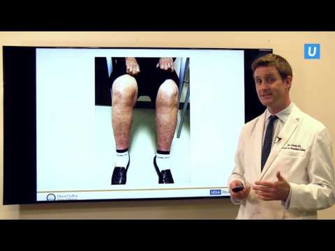 IVC Filters: What You Need to Know | John Moriarty, MD | UCLAMDChat