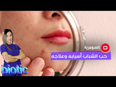 شاهد بالفيديو.. حب الشباب أسبابه وعلاجه
