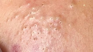 [問卦] 看人擠粉刺484很療癒