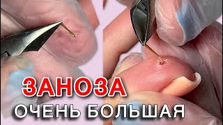 ЗАНОЗА БЫЛА ВНУТРИ 5 ДНЕЙ 🫢 ОНА ТЕПРЕЛА «до маникюра» как достать занозу кусачками? Заноза в пальце