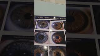 Sinais Fundamentais em Iridologia - Pterígeo