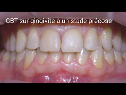 Gingivite & GBT - Guided Biofilm Therapy