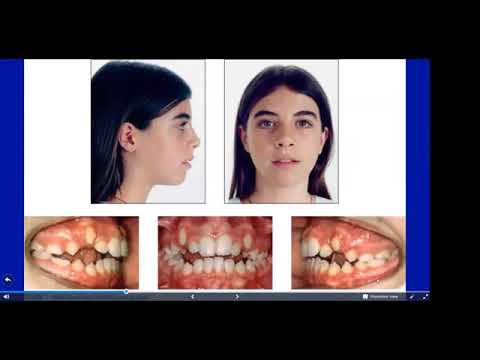 INTERCEPTIVE ORTHODONTICS  Extractions Guidelines of First Parmanent Molars