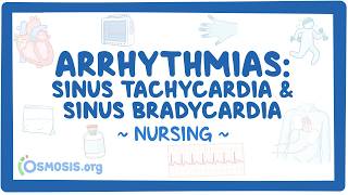 Arrhythmias - Sinus tachycardia and sinus bradycardia: Nursing