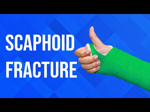 Scaphoid Fractures