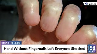 Hand Without Fingernails Left Everyone Shocked