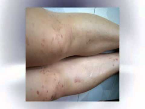 แปรง dyshydrosis หรือ disgidroticheskuyu กลาก กลากและการรักษาภายนอก