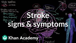 Common stroke signs and symptoms | Circulatory System and Disease | NCLEX-RN | Khan Academy