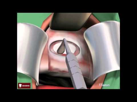 Dr. Tiziano Testori | Sinus lift 3D / Antrostomy | Zerodonto