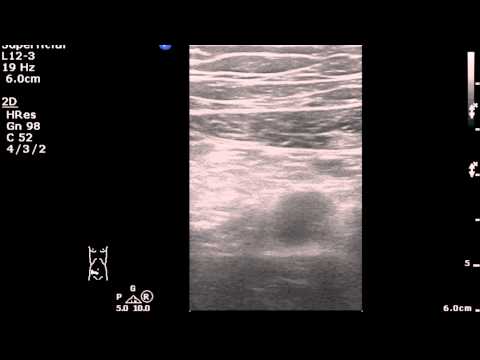 35M, complained epigastric and RLQ pain for 4 days