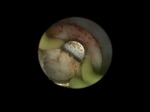 maXium® Bipolare TUR