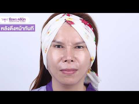 ร้อยไหม หน้าเรียว