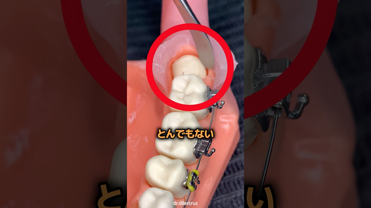 歯茎を切開したら出てきた歯の正体 🦷