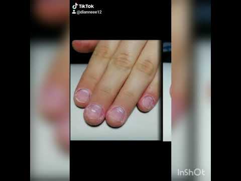 Ciuperca manichiura unghiilor