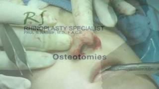 OR Video Footage: Osteotomies for Revision Rhinoplasty