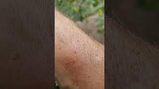 What Does a Bumble Bee Sting Look Like
